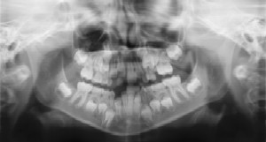  Dental Radiographs (X-Rays) - Pediatric Dentist in Jackson, New Jersey