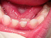 Baby Teeth - Pediatric Dentist in Jackson, New Jersey